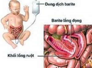 Triệu chứng lồng ruột ở trẻ em