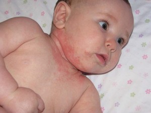 Trẻ bị dị ứng nổi mẩn ngứa, dị ứng da ở trẻ nhỏ