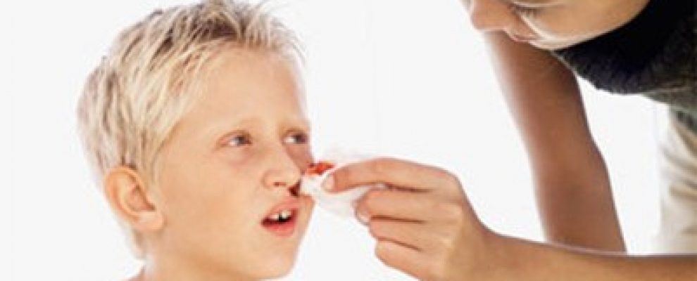 Làm gì khi trẻ chảy máu mũi?